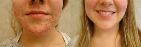 Laser Treatment For Acne at Rs 3500/each treatment in Nagpur | ID
