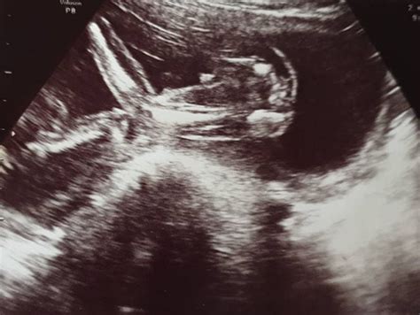 Kann man das geschlecht des babys auch ohne ultraschall erkennen? 36 Top Photos Ab Wann Sieht Man Das Geschlecht / Die Frage ...
