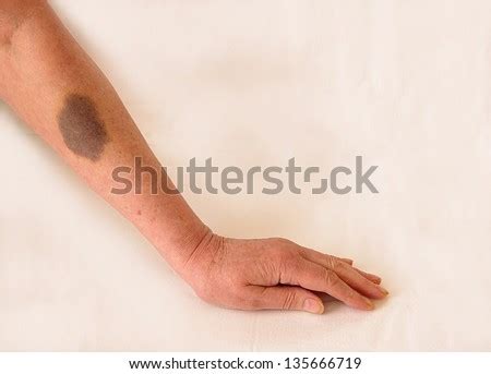 The blood vessel is punctured when blood is withdrawn during a blood test. Bruise After Drawn Blood On Arm Stock Photo 135666719 ...