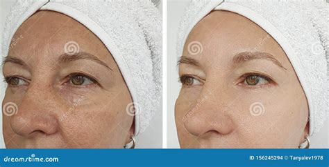Woman Face Wrinkles Removal Before And After Treatment Stock Photo