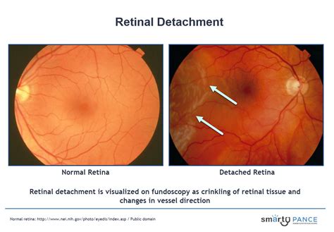 Retinal Detachment Eent Content Blueprint Smarty Pance Panre