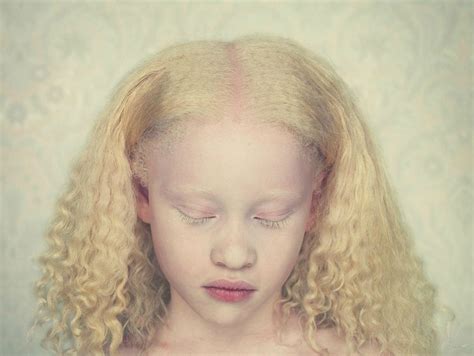 Girl With Albinism Albino White Portrait Girl Albinism Leucism And White Waves Of Color