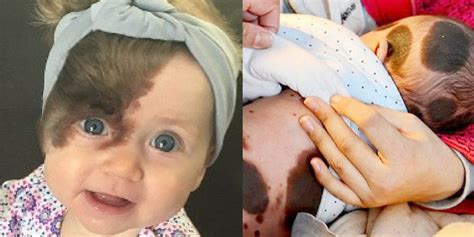 The Rarest Birthmarks To Ever Appear On Babies Babygaga