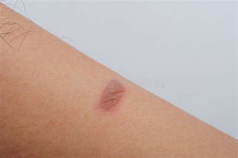 Blister Was Caused By A Burn Or Scald Sunburn Or An Allergic Reaction
