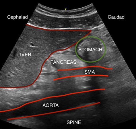 Figure Gastric Ultrasound Anatomy Including Liver Statpearls