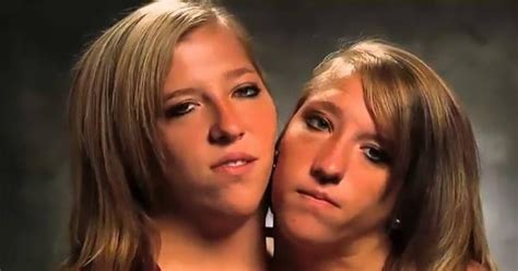Years After We Met Conjoined Twins Abby And Brittany They Are All