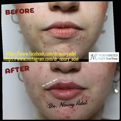 New Lip Filler Injection Approach For Russian Lips With Dr Noury Adel
