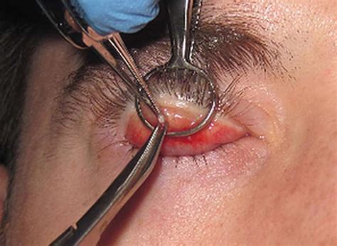 Healthool Pimple On Eyelid How To Get Rid Of 2020 Updated