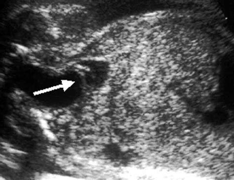 Accuracy Of Antenatal Fetal Ultrasound In The Diagnosis Of Duplex