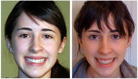 Лицо до брекетов и после Лицо до брекетов и после