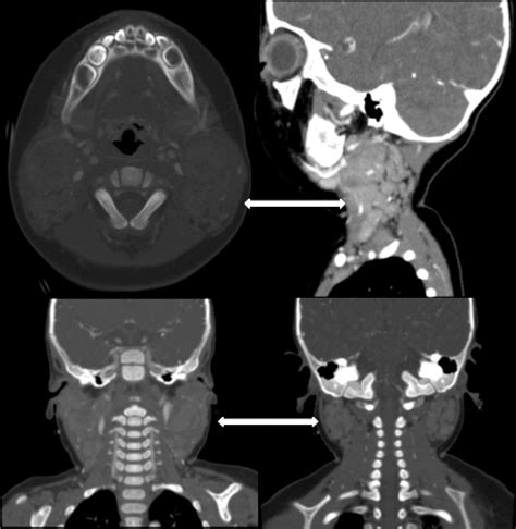 Imaging In Patients With Chronic Granulomatous Disease