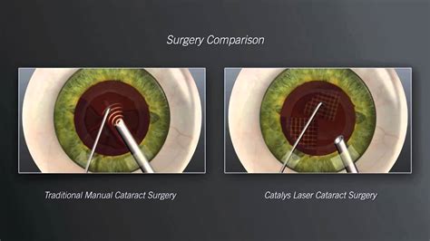 A Clear Future A Paradigm Shift In Cataract Treatment And Technology