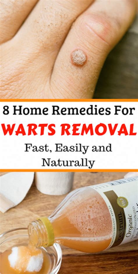 Quick Way To Remove Warts Anna Blog