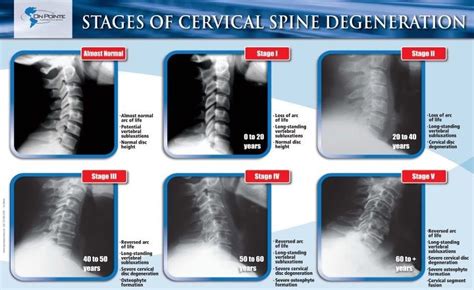 Stages Of Cervical Spine Degeneration Subluxation Radiology