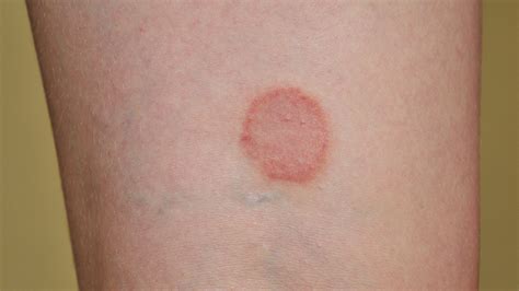 How To Get Rid Of Ringworm In Humans