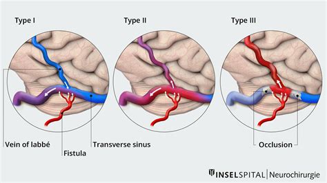 Dural Arteriovenous Fistula Inselspital Bern University Hospital