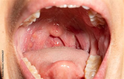 Sore Throat With Throat Swollen Closeup Open Mouth With Posterior