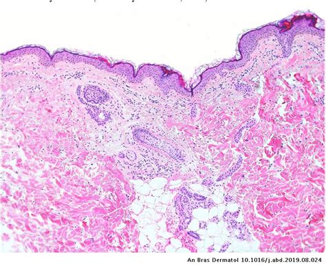 Pseudoxanthoma Elasticum Like Papillary Dermal Elastolysis In Non