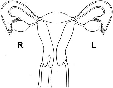 Double cervix and vagina with a normal uterus and blind cervical pouch A rare müllerian anomaly