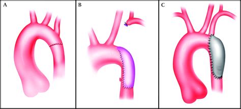 The Adult With Repaired Coarctation Of The Aorta Heart