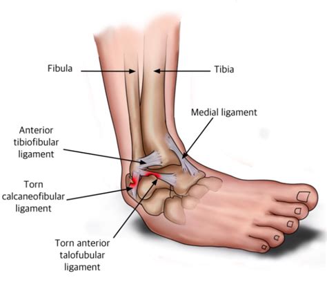 Ankle Sprain Midtown And Downtown Ny Gotham Footcare