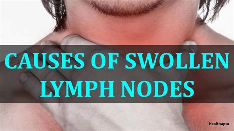 Causes Of Swollen Lymph Nodes Youtube