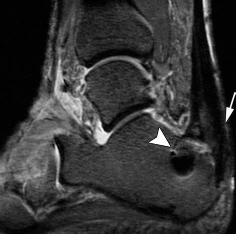 Ct And Mr Imaging Of The Postoperative Ankle And Foot Radiographics