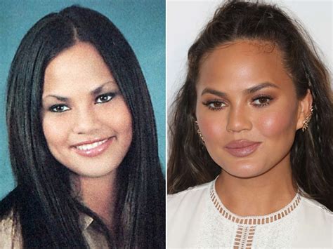 Chrissy Teigen Before And After Plastic Surgery Cheeks Nose Lips Teeth