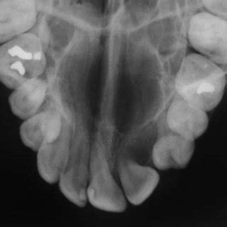 Dentigerous Cyst Associated With Ectopically Impacted Maxillary Second
