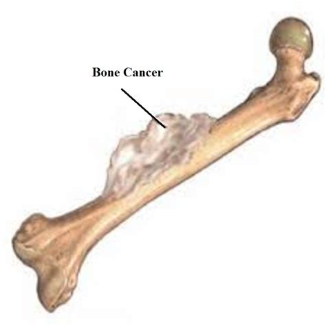 Other symptoms vary, depending on the location and size of the cancer. Bone Cancer, Symptoms, Types, Causes and Treatment ...