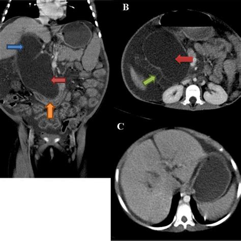 Grossly Distended Abdomen Due To Ascites Download Scientific Diagram