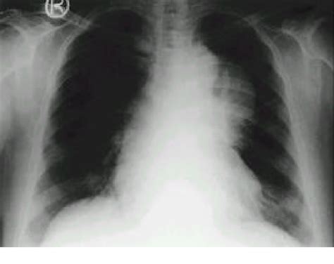 Figure 1 From A Case Of Cushings Syndrome In Acth Secreting