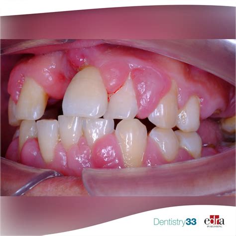 Gingival Hyperplasia