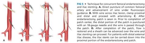 Occlusive Disease Management Iliac Angioplasty And Femoral