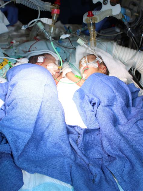 Photos Youngest Ever Conjoined Twins Cuccessfully Separated Tsb News