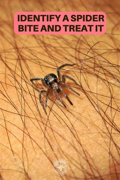 How To Identify A Spider Bite And Treat It Spider Bit Vrogue Co