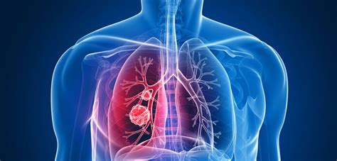 The Signs And Symptoms Of Lung Cancer ~ Gen Info