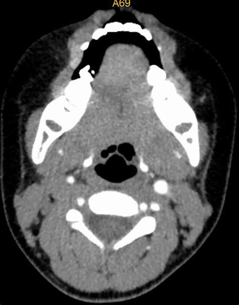 Ct Image Of No 8 Patient After Embolization Treatment Hemangioma