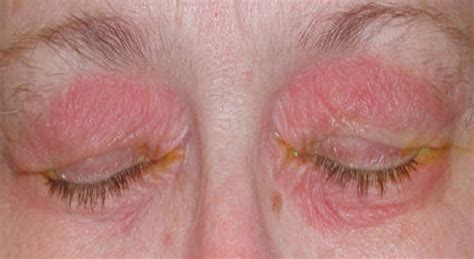 Rash On Eyelid Medical Point