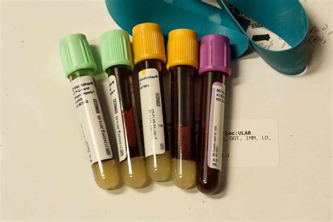 A Blood Test That Can Detect Early Stage Cancer Is Accurate Enough To