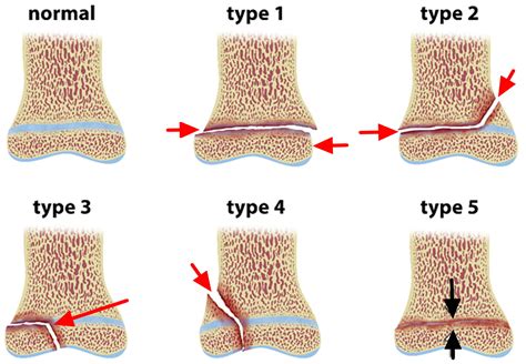 Growth Plate Fracture Causes Types Symptomstreatment