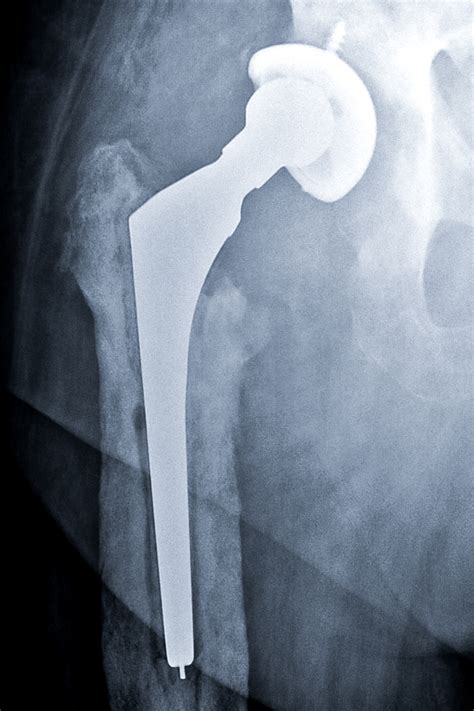 Infected Hip Replacement Adam Sassoon Md Ms
