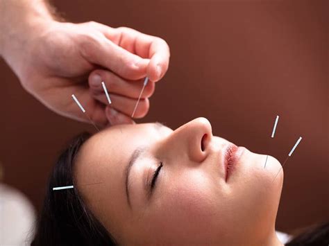 Acupuncture For Migraines And Headaches I Pillars Of Wellness