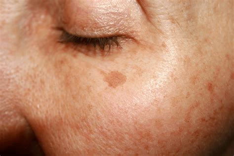 How To Get Rid Of Age Spots Healthy News