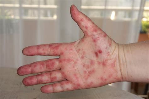 Hand Foot And Mouth Disease Is Highly Contagious