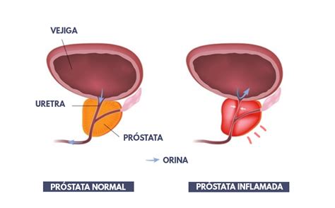 Hiperplasia Benigna De Pr Stata Hbp Y Prostatitis S Ntomas Difere