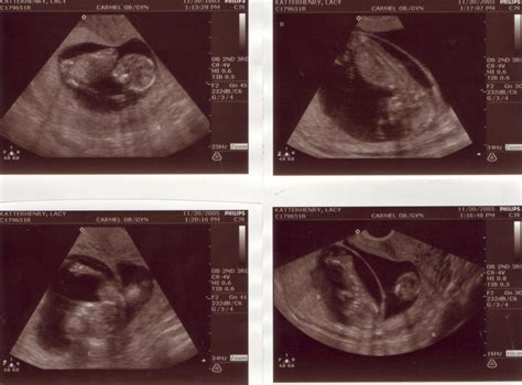 The Triplets 12 Week Ultrasound