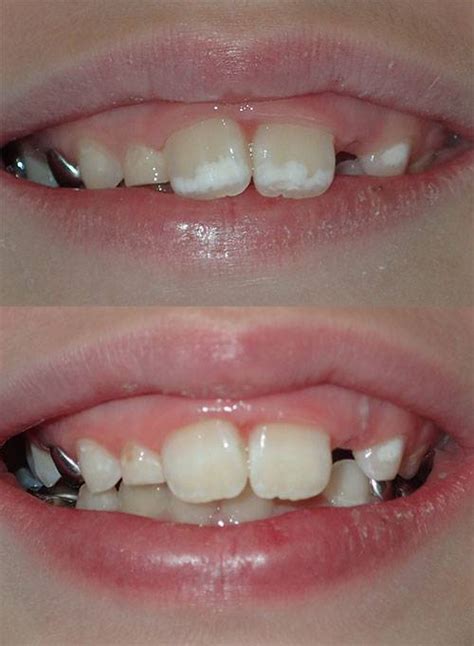 White Spot Lesions Mohr Smiles Dentistry