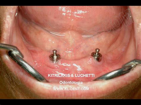 Check spelling or type a new query. Kitrilakis & Luchetti - Odontología: Implantes Dentales ...