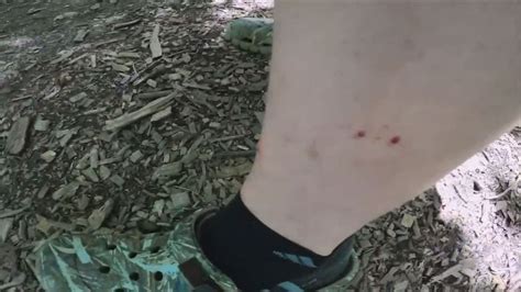 Venomous Copperhead Snake Bites Youtuber Recording Video On Maryland Trail